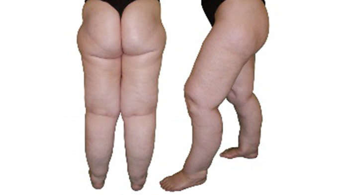 What is lipedema?